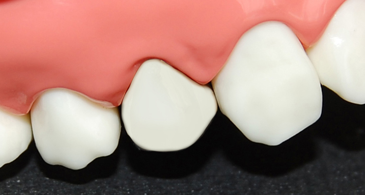 奥歯の被せ物（クラウン）CAD/CAM
